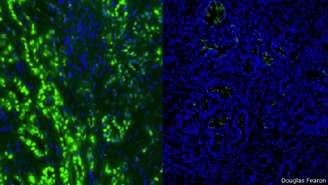 À esquerda, células de câncer no pâncreas aparecem em verde. Após o tratamento de seis dias (dir.), elas desapareceram