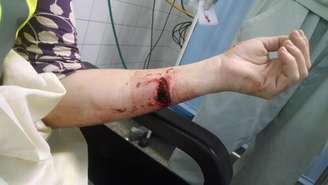 Jornalista da CNN postou em seu Twitter ferimento no braço após confronto entre manifestantes e PMs