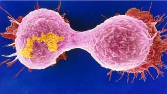 Mutação genética que leva à leucemia também pode causar câncer de mama agressivo