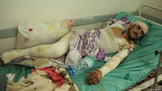 Homem com graves queimaduras está internado no hospital Jumhuriya, em Sanaa. Sessenta por cento dos iemenitas não têm acesso a tratamento médico