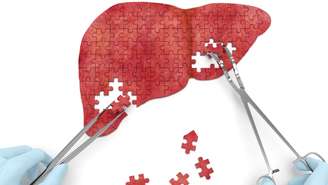 A hepatite ataca o fígado e pode ser fatal