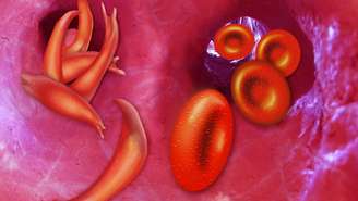 Anemia falciforme ganhou esse nome por causa da deformação que causa nos glóbulos vermelhos, dando-lhes formato de foice