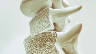 A osteoporose acomete mais mulheres - estima-se que sejam 200 milhões delas afetadas no mundo todo