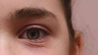 Rinite: pregas abaixo dos olhos está entre os sintomas da alergia