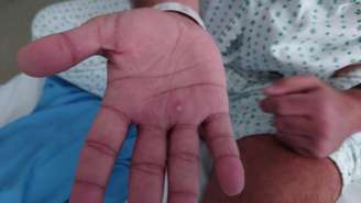 Homem mostra sintomas da varíola dos macacos nas mãos | Foto ilustrativa 