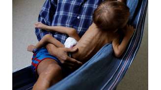 Criança yanomami de 4 anos internada em hospital de Boa Vista para tratar desnutrição