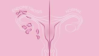 Saiba os principais exames para diagnosticar a endometriose -