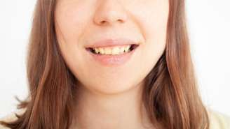 As manchas nos dentes são causadas por diversos fatores -