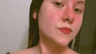 A influenciadora digital Flávia Leonel Santana tinha manchas avermelhadas na pele e pequenas bolhas