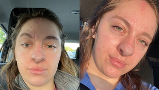 Nariz de jovem começa a ter cabelo após receber enxerto