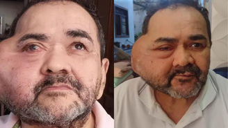 José Nilton Cardozo tomava 18 doses de morfina ao dia para lidar com dores do tumor