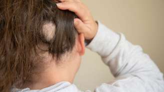 A alopecia pode estar associada a estresse e falta de vitaminas -