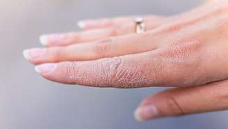 Veja como certos componentes podem ajudar a tratar as mãos ressecadas - Shutterstock