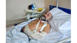 Italiano pode recuperar uso da mão após transplante de nervo de perna amputada