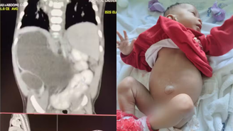 Imagens foram cedidas pelo médico responsável pelo caso, o urologista-pediátrico Hélio Buson