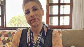 Maria Teresa, 51 anos, foi atacada pelo cachorro da própria família