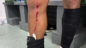 O ferimento na perna do atacante.