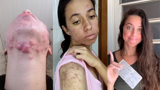 Brasileira usa redes sociais para mostrar sua batalha contra a acne severa
