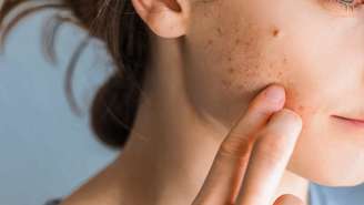 Saiba como não errar no tratamento para acne