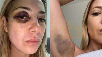 Ex-primeira-dama da Argentina mostra hematomas após agressões de Fernández: 'Você me bate há 3 dias'