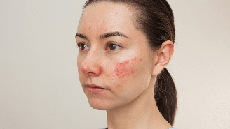 A convivência com altos níveis de estresse podem influenciar no agravamento da acne / Foto: Shutterstock