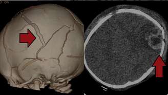 Sangramento no cérebro (esq.) e fratura no crânio (dir.) causados pela síndrome do bebê sacudido