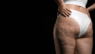 O lipedema resulta no acúmulo de gordura, se assemelhando à celulite / Foto: Shutterstock