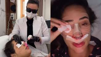 Deniziane exibe curativo após rinoplastia e desabafa: ‘Arde demais!’