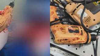 Vídeos mostram uso de furadeiras domésticas em cirurgias em hospital de SP