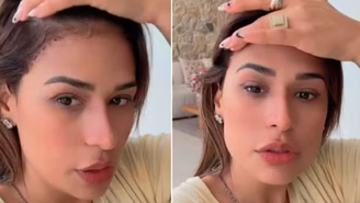 Simone Mendes passa por cirurgia no rosto e revela motivo: 'Eu tinha'