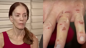 Marília de Godoy mostra dedos machucados após ser assaltada a dentadas