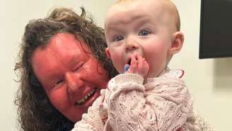 Georgina Burrough nasceu com uma condição genética da pele extremamente rara. Ela teve duas filhas saudáveis, que não herdaram sua condição