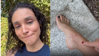 Débora Nascimento mostra picadas de mosquito