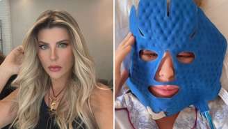 Íris Stefanelli compartilhou primeiros resultados do lifting facial nesta quinta-feira (19)
