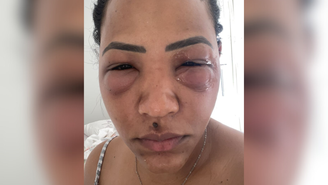 ‘Meu olho estava enorme’: mulher tem infecção grave após erro em aplicação de ácido hialurônico nas olheiras