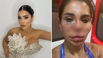 Influenciadora francesa fica desconfigurada após sofrer ataque brutal por homens armados