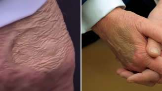 Antes de diagnóstico, Trump foi flagrado com mão maquiada e pés inchados