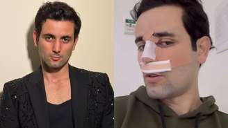 Matteus Amaral exibiu o resultado de sua rinoplastia