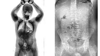 Raio-x mostrou pacotes de maconha no intestino do homem