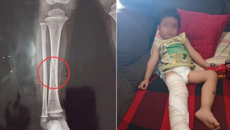 Criança de dois anos quebra perna enquanto estava na escola em Peruíbe