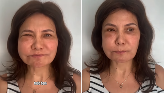 Mulher tem reação alérgica a ácido hialurônico mais de um ano após preenchimento: ‘Acordei desse jeito’