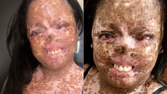 Juliana Flores descreve rotina com xeroderma pigmentoso: 'sair de casa só à noite'