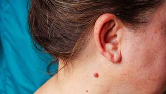 A abordagem mais segura é buscar acompanhamento médico antes de tentar qualquer intervenção na verruga – depositphotos.com / Kinderkz