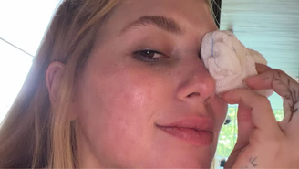 Virgnia aparece com lesão no olho após acidente com Maria Flor