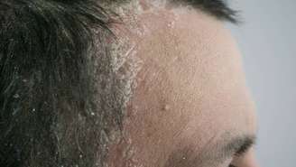 muitas pessoas procuram alternativas para tornar o dia a dia mais fácil, minimizando seus sintomas e aprendendo a lidar de forma adequada com a manifestação da seborreia – depositphotos.com / SergeVo