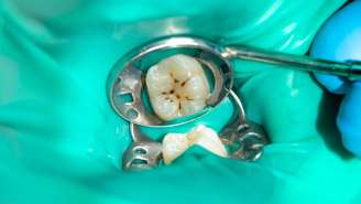 A avaliação periódica de dentes restaurados com amálgama é recomendada para garantir a saúde bucal e prevenir problemas maiores – depositphotos.com / schigirin91@gmail.com