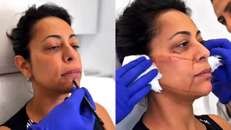 UAU! Samantha Schmütz faz procedimento no rosto com mesmo médico das Kardashians / Reprodução: Instagram