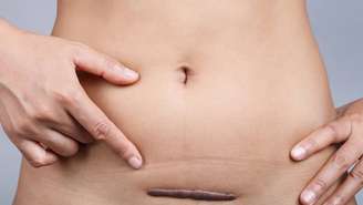 Genética, tipo de pele, local da ferida e intensidade da inflamação estão entre os principais fatores que aumentam o risco de formação de queloides – depositphotos.com / sukr13