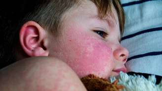 rubéola – depositphotos.com / milastokerpro