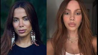 Antes e depois dos procedimentos feitos pela Anitta